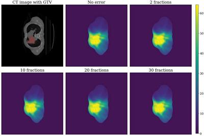 Impact of Interfractional Error on Dosiomic Features